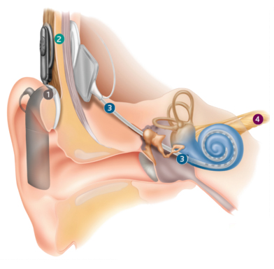 Как работает бионическое ухо