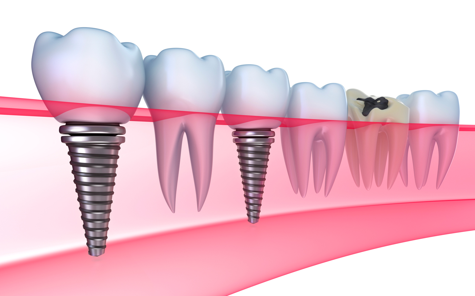 Восстановление зубов технологии будущего